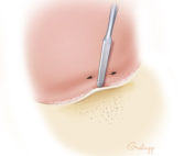 Commencing elevation of the ear canal flap (skin and periosteum) from Henle’s spine. Note the cribriform region just posterior to the spine.