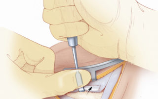 Using a periosteal elevator, the mastoid cortex is exposed first by elevating toward the ear canal. Technique shown employing a Lempert periosteal elevator. Using a periosteal elevator, the mastoid cortex is exposed first by elevating toward the ear canal. Technique shown employing a Lempert periosteal elevator.