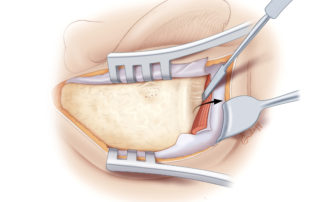 The temporalis muscle is elevated from the linea temporalis. Note that a small relaxing incision is often made posteriorly. The temporalis muscle is elevated from the linea temporalis. Note that a small relaxing incision is often made posteriorly.