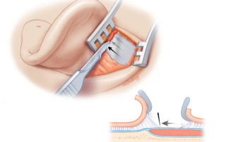 Sweeping with a scalpel while clicking open the mastoid retractor to maintain tension in the soft tissues expedites identification of the temporalis fascia. Note that the scalpel blade is tilted superiorly. If directed inferiorly, it tends to cut into the fascia and can even open the roof of the external auditory canal. Sweeping with a scalpel while clicking open the mastoid retractor to maintain tension in the soft tissues expedites identification of the temporalis fascia. Note that the scalpel blade is tilted superiorly. If directed inferiorly, it tends to cut into the fascia and can even open the roof of the external auditory canal.