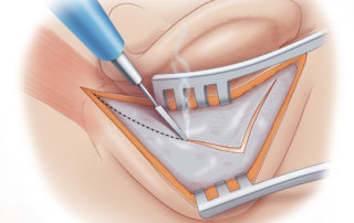 Periosteum is then opened over the cortex to the mastoid tip. Periosteum is then opened over the cortex to the mastoid tip.