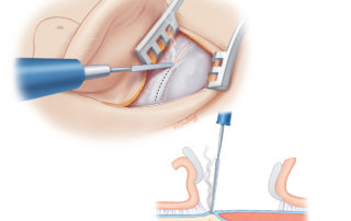 Electrocautery is used to make an incision along the linea temporalis. A posterior branch of the superficial temporal artery often needs to be controlled at the anterior aspect of the incision. Electrocautery is used to make an incision along the linea temporalis. A posterior branch of the superficial temporal artery often needs to be controlled at the anterior aspect of the incision.
