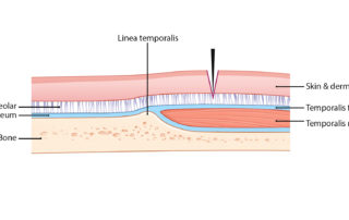Soft-tissue layers illustrated in relation to the linea temporalis. Soft-tissue layers illustrated in relation to the linea temporalis.