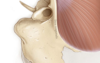 The temporalis muscle lives in a fossa whose lower edge is the linea temporalis: an important landmark in opening the ear from behind. The temporalis muscle lives in a fossa whose lower edge is the linea temporalis: an important landmark in opening the ear from behind.