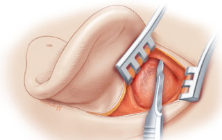 During dissection above the ear, a hood commonly develops, which should be sharply parted. During dissection above the ear, a hood commonly develops, which should be sharply parted.