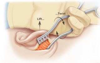 The next goal is to identify the temporalis fascia and linea temporalis. Use of a mastoid retractor to place the tissue under tension aids in this process. The superficial layers can be opened expeditiously with electrocautery. The next goal is to identify the temporalis fascia and linea temporalis. Use of a mastoid retractor to place the tissue under tension aids in this process. The superficial layers can be opened expeditiously with electrocautery.