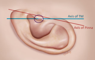 The pinna tilts posterior about 15 degrees with respect to the axis of the malleus. The pinna tilts posterior about 15 degrees with respect to the axis of the malleus.