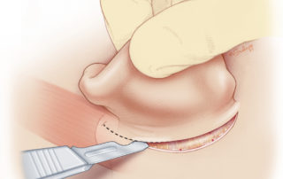Incision is carried through the dermis with a scalpel. Some surgeons open the skin with electrocautery. Incision is carried through the dermis with a scalpel. Some surgeons open the skin with electrocautery.