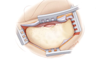 Completed exposure for mastoidectomy. Two retractors are set, one spanning from the ear canal to the sinodural angle. Care must be taken when opening this retractor lest the meatal skin be torn. Liberating the meatal skin from the osseous meatus reduces this likelihood. The second retractor elevates the temporalis muscle and depresses the sternocleidomastoid muscle. Completed exposure for mastoidectomy. Two retractors are set, one spanning from the ear canal to the sinodural angle. Care must be taken when opening this retractor lest the meatal skin be torn. Liberating the meatal skin from the osseous meatus reduces this likelihood. The second retractor elevates the temporalis muscle and depresses the sternocleidomastoid muscle.