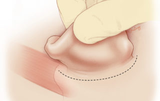 Postauricular incision may be done in the sulcus, but incisions 5 to 10 mm behind the sulcus heal well and are less likely to retract. Note that the incision is carried forward in its superior limb to enable the ear to be turned forward for unhindered access to the structures of the middle ear. Inferiorly, the incision carries over the mastoid tip. In infants and very young children, who have not yet developed a mastoid tip, the incision should not be carried inferiorly to the same degree as it risks facial nerve injury. Postauricular incision may be done in the sulcus, but incisions 5 to 10 mm behind the sulcus heal well and are less likely to retract. Note that the incision is carried forward in its superior limb to enable the ear to be turned forward for unhindered access to the structures of the middle ear. Inferiorly, the incision carries over the mastoid tip. In infants and very young children, who have not yet developed a mastoid tip, the incision should not be carried inferiorly to the same degree as it risks facial nerve injury.
