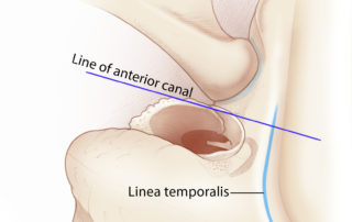 The incision of periosteum along the linea temporalis should be carried forward to the level of the anterior aspect of the ear canal so that the soft tissues rotate forward to enable a full view down the ear canal to the middle ear structures. The incision of periosteum along the linea temporalis should be carried forward to the level of the anterior aspect of the ear canal so that the soft tissues rotate forward to enable a full view down the ear canal to the middle ear structures.