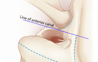 After the superior incision has been completed, if mastoidectomy is planned the periosteum is then opened over the cortex to the mastoid tip. If only postauricular tympanoplasty is planned, then the periosteal incision can be made closely behind the ear canal. After the superior incision has been completed, if mastoidectomy is planned the periosteum is then opened over the cortex to the mastoid tip. If only postauricular tympanoplasty is planned, then the periosteal incision can be made closely behind the ear canal.