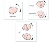 The three variables for positioning of the head in ear microsurgery: rotation, tilt, and flexion–extension.