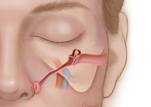 Frontal view of Eustachian tube. Eustachian tube is a curved structure that is usually at a 30-degree angle from the middle ear cavity and curves anteriorly toward the nasopharynx.