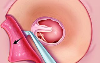 Window shading of vascular strip flap superiorly.