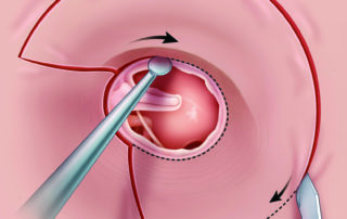 The remaining canal skin and periosteum are dissected from the bony canal and placed aside for later use as a free graft. Note that the medial incision is placed just lateral to the tympanic annulus.