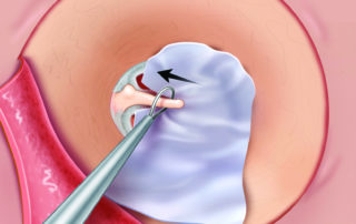 Placement of the fascia graft over the tympanic membrane remnant. A wire loop may be used to position the graft beneath the umbo.