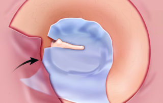 Replacement of the superior flap overlapping the fascia graft.