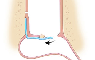 Classical medial fascia graft tympanoplasty failure due to graft retraction during healing.