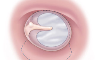 Classical medial fascia graft tympanoplasty with insufficient purchase anteriorly has a higher rate of failure.