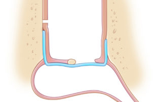 Anterior “window shade” technique.