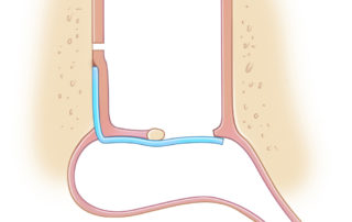 Classical medial fascia graft tympanoplasty with insufficient purchase anteriorly has a higher rate of failure.
