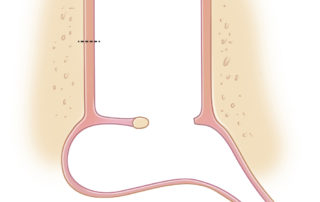 Anterior tympanic membrane perforation. Dotted line represents canal skin = incision.