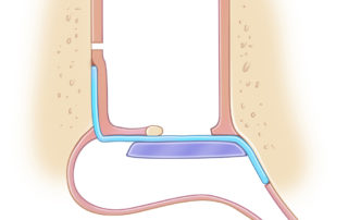 Reinforcing anterior tympanic membrane perforation repair with cartilage. This is the preferred method of the author.