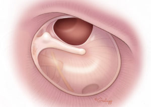 Anterior tympanic membrane perforations are more technically challenging and have a higher reperforation rate unless specialized techniques are utilized. Canaloplasty to remove overhanging anterior canal bulge is commonly needed.