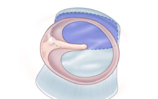 Reinforcing anterior tympanic membrane perforation repair with cartilage.