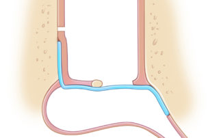 Supplemental graft length in protympanum.