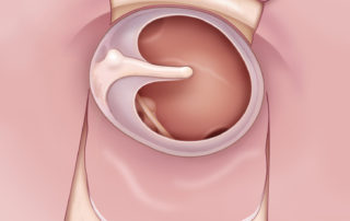 Anterior flap elevation in “window shade” technique.