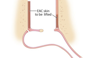 Flap elevation in “window shade” technique.