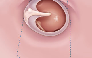 Anterior incisions in “window shade” technique.