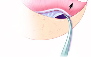 The tympanic mucosa is lysed with a curved needle. When done under local, lidocaine is infused into the middle ear to anesthetize the tympanic mucosa. To avoid anesthetizing the labyrinth with resultant postoperative vertigo, lidocaine should be promptly suctioned from the middle ear, especially from the round window niche where it tends to accumulate.