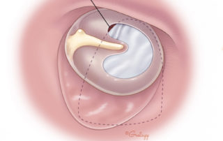 Usually the graft is not optimally adjusted after its initial placement. It is essential in tympanoplasty that the graft underlies the margin of the perforation significantly to foster its vascularization and integration with the tympanic membrane remnant.