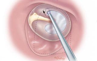 Adjusting the graft into position using a wire loop. If suction is needed, use a small diameter suction (e.g., no. 3 Fr or no. 20 needle) and keep an instrument (e.g., annulus elevator or wire loop) between the suction and graft. When using a suction near a graft in position, it is prudent to request your assistant to be ready to plug the suction so that it can be disengaged without disturbing the graft.