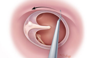 Scoring the mucosa in the protympanum is important for graft adhesion in anterior marginal perforations.