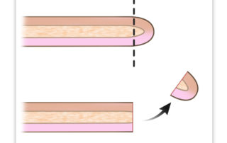 The concept of perforation rimming is to remove the epithelial margin of the perforation.
