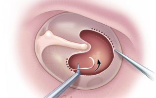 A classical technique of rimming is to create a “pie crust” edge with a needle and then stripping the rimming with a hook or cup forceps.