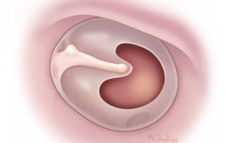 Typical central tympanic membrane perforation. Most microsurgical tympanic membrane perforations are managed via medial grafting.