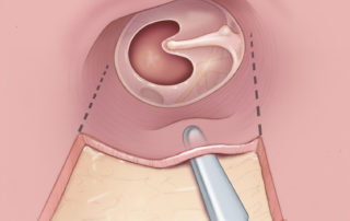 Working via the postauricular approach flap elevation can be done with larger periosteal elevators.