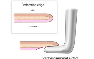 The concept of disrupting the medial mucosal layer of the tympanic membrane is that it encourages vascularization of the graft.