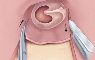 From the postauricular approach, the tympanomeatal flap can be cut rapidly with scissors or a blade rather than microsurgical instruments.