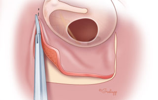 Cutting the vascular strip with microscissors reduces bleeding and achieves a cleaner incision.