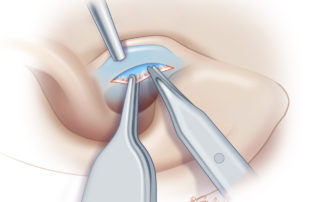 Scissor dissection establishes the plane.