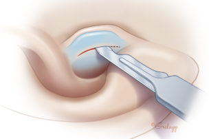 In cartilage and/or perichondrium harvesting, the incision is hidden on the canal side of the tragus.
