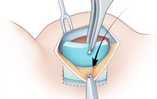 If only perichondrium is needed, the cartilage can be replaced.