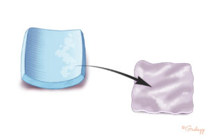 Perichondrial graft is separated.