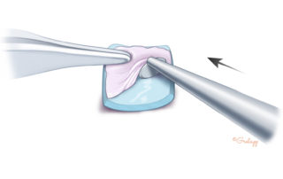 Dissection of perichondrium from the cartilage with a stapes knife.